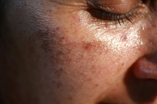 Tout ce que vous devez savoir sur l'hyperpigmentation